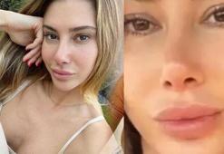 Estetik ameliyatı olan Şeyma Subaşı hastanelik mi oldu?