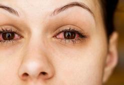 Göz enfeksiyonu ile alerjik konjonktivit nasıl ayırt edilir?