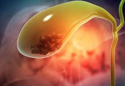 Hazımsızlık ve şişkinliğe dikkat! Sebebi safra kesesi olabilir