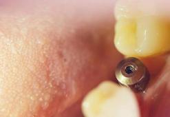 Diş implantı yaptırmadan önce bilinmesi gereken önemli noktalar