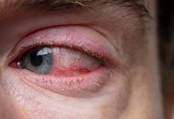 Mevsimsel alerjinin etkilerinden gözlerimizi korumanın yolları