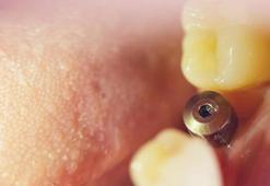 Diş implantları kimlere yapılır, ne işe yarar?