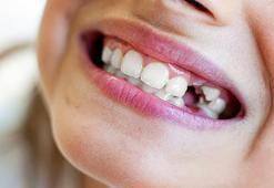 Diş travması yaşayan çocuklarda acil müdahale nasıl yapılır?