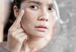 Güneş ışınlarının cilde zararları