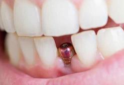 Diş implantları ile gerçek diş arasında bir fark var mı?