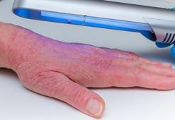 Sedef, egzama ve vitiligo hastalığında fototerapinin önemi