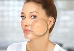 Güneş lekelerine mezoterapi dokunuşu