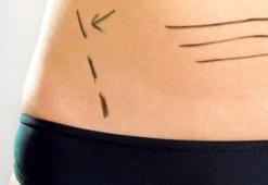 Hamilelik sonrası karın sarkması çözülebilir bir problemdir!