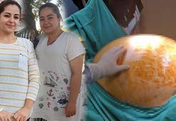 Tümör alınınca 91 kilodan 70 kiloya düştü! Hamileyken karnım bu kadar büyümemişti