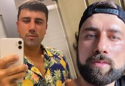 Burun estetiği yaptıran Survivor Yasin Obuz'un son hali!