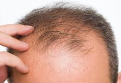 Saç dökülmesinin önüne geçmek zor değil!