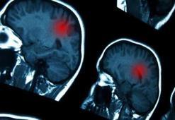 İnme hakkında doğru sanılan 5 yanlış