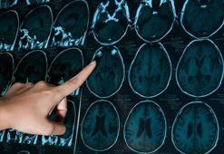 Pandemide inme belirtilerine rağmen hastalar doktora gitmedi!