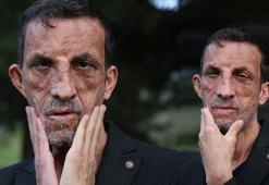 Türkiye'nin ilk yüz nakliyle hayatı değişen Acar'dan anlamlı çağrı