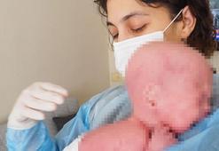 300 milyonda bir görülen hastalık! Gökdeniz bebek 1 yaşında