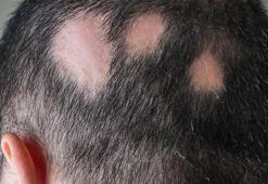 Duygusal travmalar saçkırana sebep oluyor! 'Sarımsak sürmek iyi geliyor'