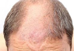 Saç ekiminde bilinmesi gereken olmazsa olmaz 10 doğru