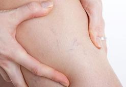 Varisi olanlar pandemide dikkat! Kovid-19 ve varisin ortak riski kan pıhtısı