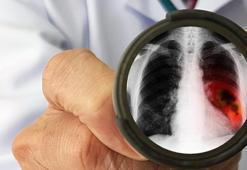 Erken evre akciğer kanserinde yüz güldüren yöntem! İyileşme süresini kısaltıyor