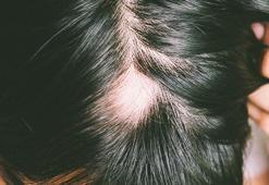 Oscar ödül törenine damga vuran hastalık: Alopesi areata nedir, tedavisi var mı?