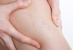 Bacaklarınız ve ayak bileklerinizdeki renk değişimine dikkat!