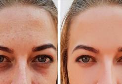 Göz altındaki morluklar kader değil! Tembel damarları çalıştırarak tedavi ediyor