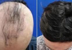 6 ay sonra yeniden saçları çıktı! 'Bu ilaç umut olabilir'