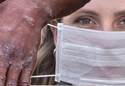 Uzmanı uyardı! 42 yaş altı maymun çiçeği enfeksiyonuna açık