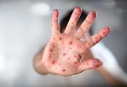 Kovid-19 pandemisi kızamık vakalarının artmasına yol açtı