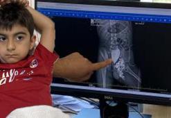Çok feci olay! Minibüsün ezdiği çocuğun idrar kanalı koptu