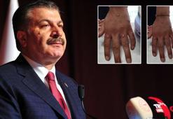 Türkiye'de vaka var mı? Bakan Koca'dan maymun çiçeği açıklaması
