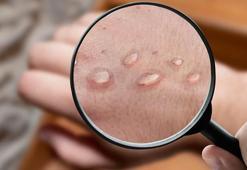 Çiçek aşısı olanların maymun çiçeğinden korunma oranı yüzde 85