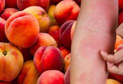 Şeftali yedikten 2 saat sonra ortaya çıkıyor! İlk belirtisi kaşınma ve şişme