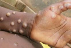 MAYMUN ÇİÇEĞİ BELİRTİLERİ neler? Maymun Çiçeği Hastalığı hangi ülkelerde var, tedavisi var mı, tanısı nasıl konur?