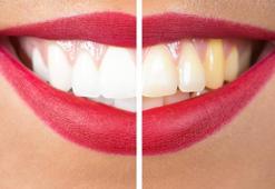 Diş beyazlatmadan sonra beyazlatmanın ömrünü uzatmanın yolu