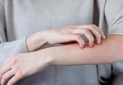 Yaz mevsiminde en çok görülen cilt hastalıkları