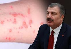 Bakan Koca: Türkiye'de 5 maymun çiçeği vakası tespit edildi