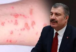 Bakan Koca: Türkiye'de 5 maymun çiçeği vakası tespit edildi