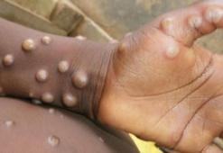Maymun çiçeği virüsü 92 ülkede görüldü: Dünya genelindeki vaka sayısı 35 bini aştı