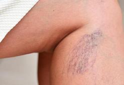 Tedavi edilmezse ne olur: Varis hakkında en merak edilen 9 detay