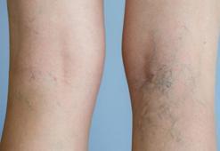 Rakam rakam varis hastalığıyla ilgili gerçekler! Ev kadını ve emeklilerde risk büyük