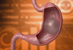 Yutulabilir mide balonu ile nasıl kilo verilir? En çok merak edilen sorular yanıtlandı