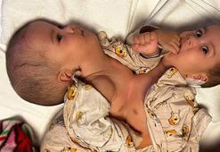 9 saat süren operasyon! Dünya literatürüne giren siyam ikizleri taburcu oluyor