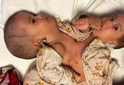 Dünya literatürüne giren siyam ikizleri taburcu oluyor