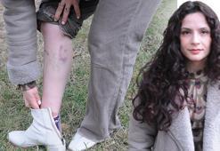 Köpeklerin saldırısında yaralanan Duygu, yaşananları anlattı