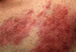 Son 10 yılda görülenden daha fazla! Zona vakalarını hortlattı