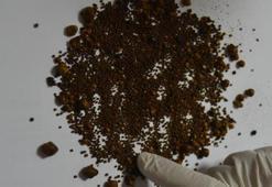 Doktor bile şoke oldu! Safra kesesinden 4 bin 536 taş çıktı