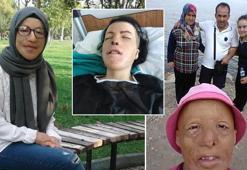 Bebekken eli, yüzü ve vücudu yandı, 2 yaşından beri 47 kez ameliyat oldu