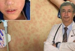 Yıllardır görülmeyen vakalar yeniden ortaya çıktı! Hamile bir kadına bulaşırsa bebeği ölebilir, sakat doğabilir