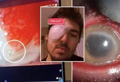 Lensleriyle uykuya daldı, kör oldu! 'Kornea' yiyen bakteri gözünden etti